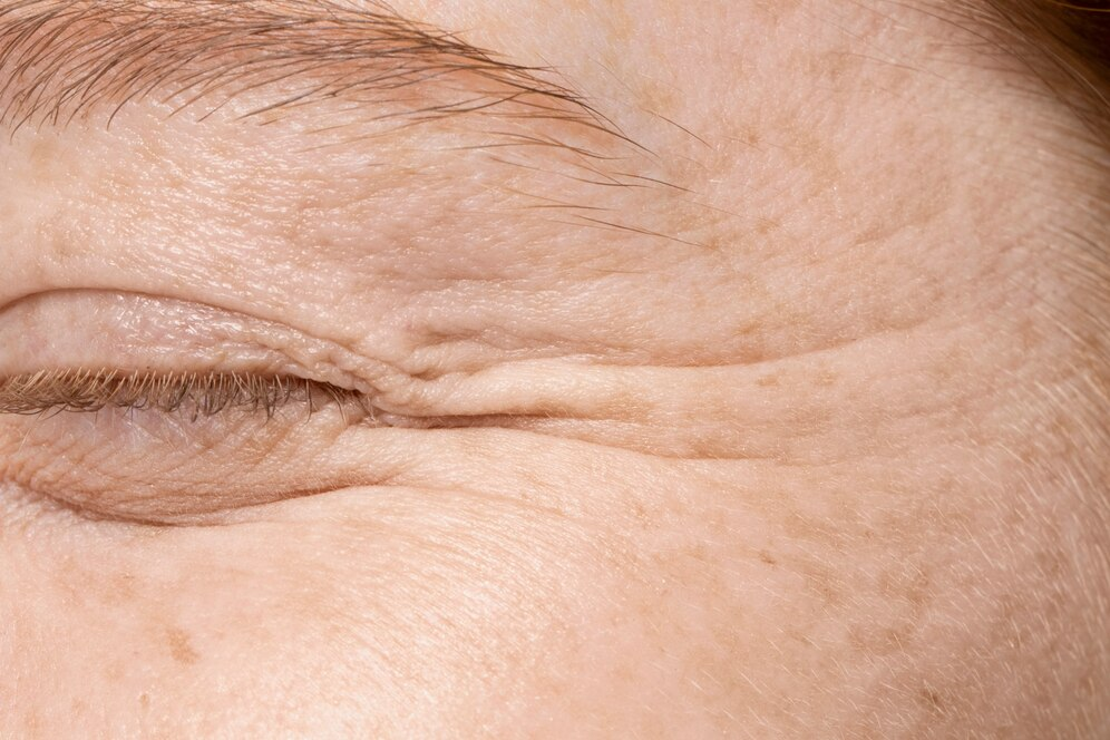 Endotine facelift